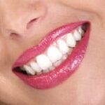 Behandlung Keramikinlay